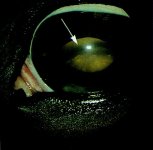 Lens luxation in a horse\'s eye.jpg