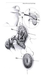 prolapse.jpg